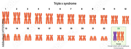 Karyotype of Triple x syndrome. XXX. Female has an extra X chromosome. Chromosome abnormality. photo