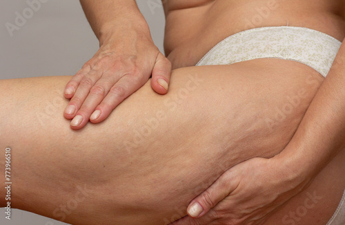 Cropped woman body with hands on leg pressing skin to show cellulite over gray background