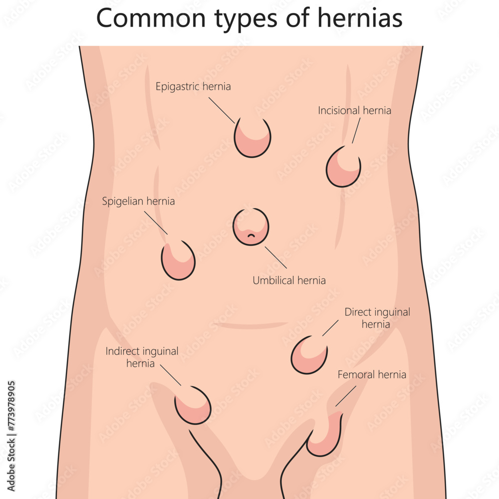 Human various hernia types on human abdomen for health and medical studies structure diagram hand drawn schematic vector illustration. Medical science educational illustration - obrazy, fototapety, plakaty 