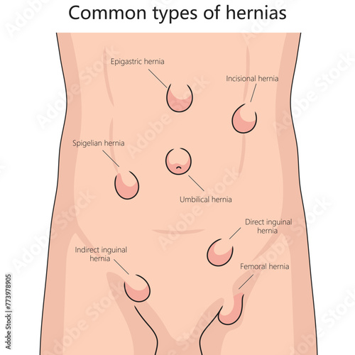Human various hernia types on human abdomen for health and medical studies structure diagram hand drawn schematic vector illustration. Medical science educational illustration photo