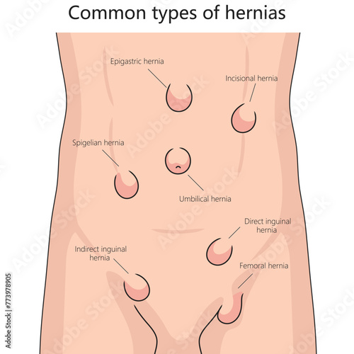 Human various hernia types on human abdomen for health and medical studies structure diagram hand drawn schematic vector illustration. Medical science educational illustration