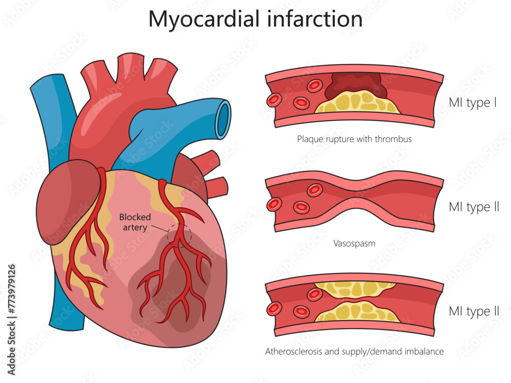 Human heart anatomy and different types of myocardial infarction for