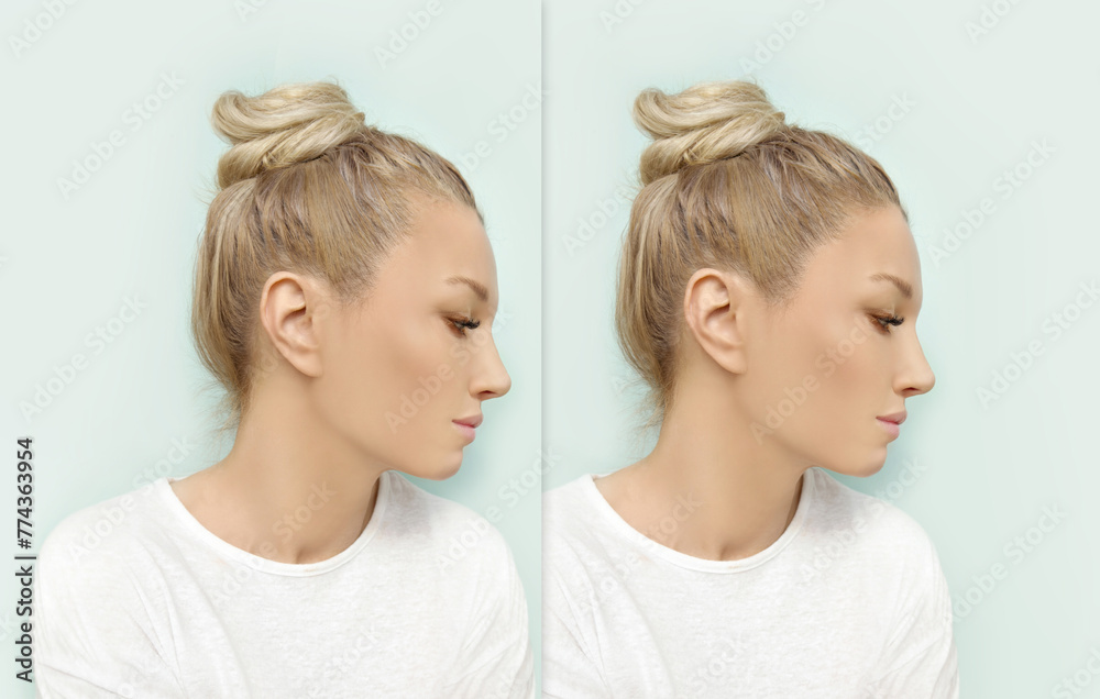 Thinning hair and hair loss,female pattern baldness,Hair transplant Thinning hair and hair loss,female pattern baldness,Hair transplant