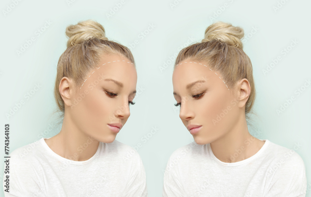 Thinning hair and hair loss,female pattern baldness,Hair transplant Thinning hair and hair loss,female pattern baldness,Hair transplant