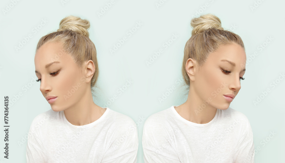 Thinning hair and hair loss,female pattern baldness,Hair transplant Thinning hair and hair loss,female pattern baldness,Hair transplant
