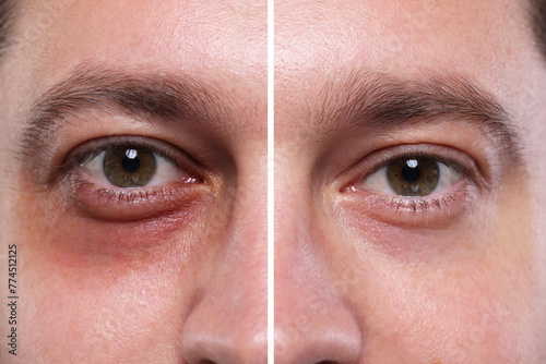 Collage with photos of man with dark circle under eye before and after treatment, closeup