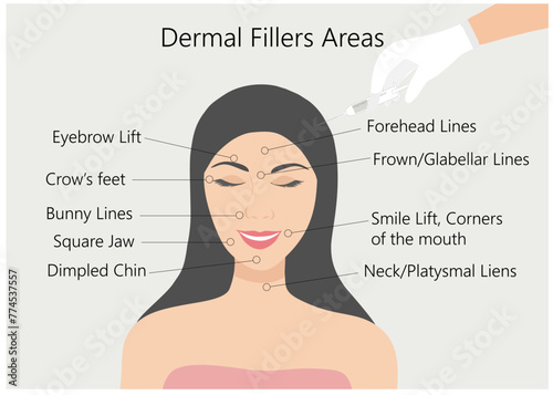 Dermal filler and botox injections areas. Woman face with doctor hands in gloves with syringe. Beauty lifting anti-aging treatment vector illustration.