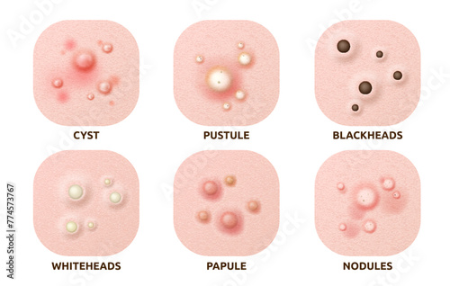 Body skin acne type blackheads, whiteheads, papule, pustule, cyst and nodules. Realistic 3d vector skin disease caused by excess oil production, bacteria, and inflammation, hormonal changes or sweat