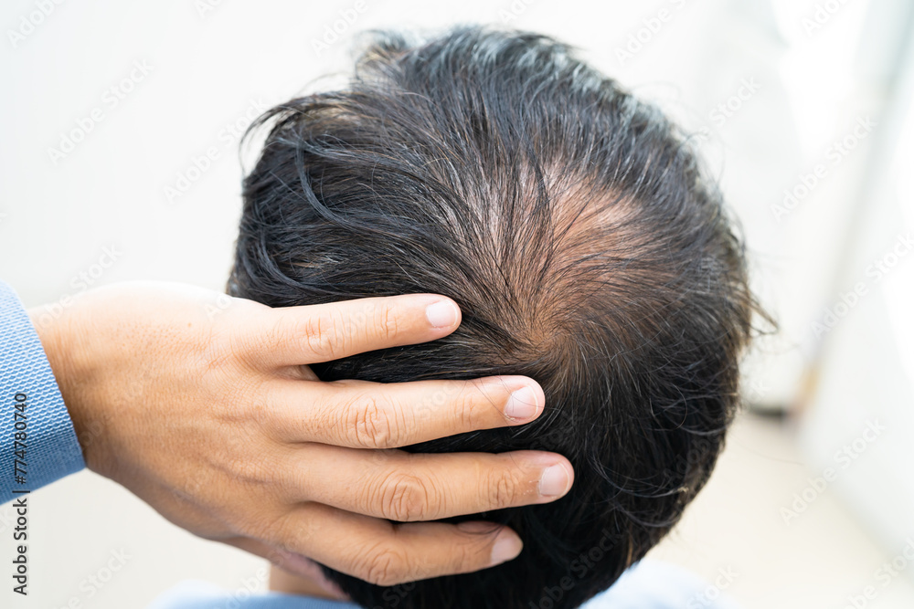 Φωτογραφία Bald in the middle head and begin no loss hair glabrous of mature Asian business smart active office man