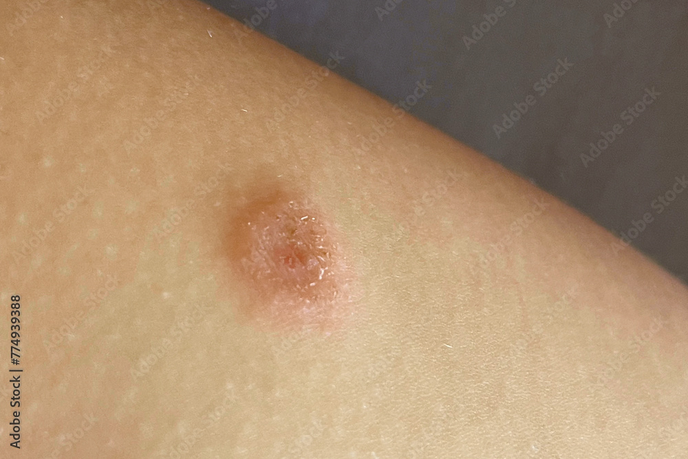 Fototapeta premium Close up of skin problem. Infectious disease. Allergy, dermatitis, virus or bacterial infection. Dermatology, medicine and health care concept.