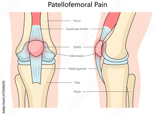 Patellofemoral pain syndrome structure diagram hand drawn schematic vector illustration. Medical science educational illustration