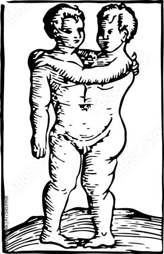 Striking illustration of conjoined twins, suitable for medical history, educational content, and discussion of human diversity.