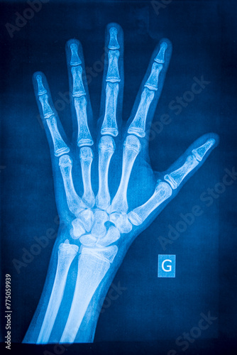 Normal left hand radiograph. Radiography