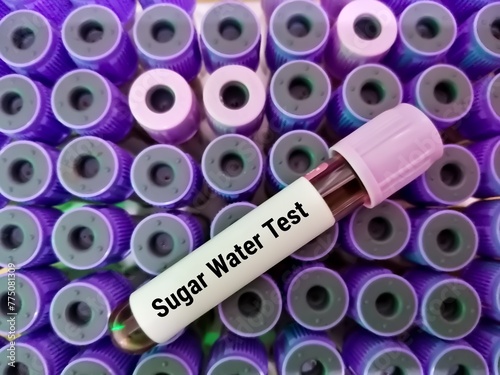 Blood sample for Sugar Water Test, to diagnose paroxysmal nocturnal hemoglobinuria (PNH). HAM'S Test.