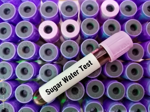 Blood sample for Sugar Water Test, to diagnose paroxysmal nocturnal hemoglobinuria (PNH). HAM'S Test. photo