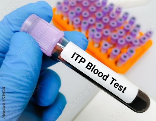 Immune thrombocytopenic purpura (ITP) test, ITP is a blood disorder characterized by a decrease in the number of platelets in the blood.