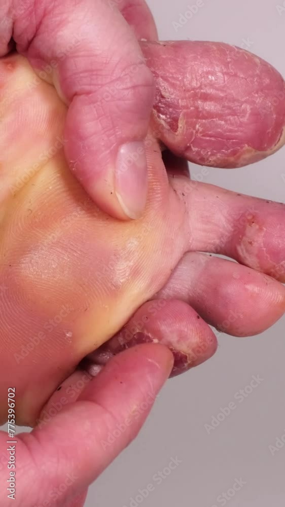 Woman scratches her toes with her finger. Huge wound on female foot after several confluent blisters of eczema. Acute psoriasis, chemical irritation, allergic reaction, dermatological disease on foot. Woman scratches her toes with her finger. Huge wound on female foot after several confluent blisters of eczema. Acute psoriasis, chemical irritation, allergic reaction, dermatological disease on foot.