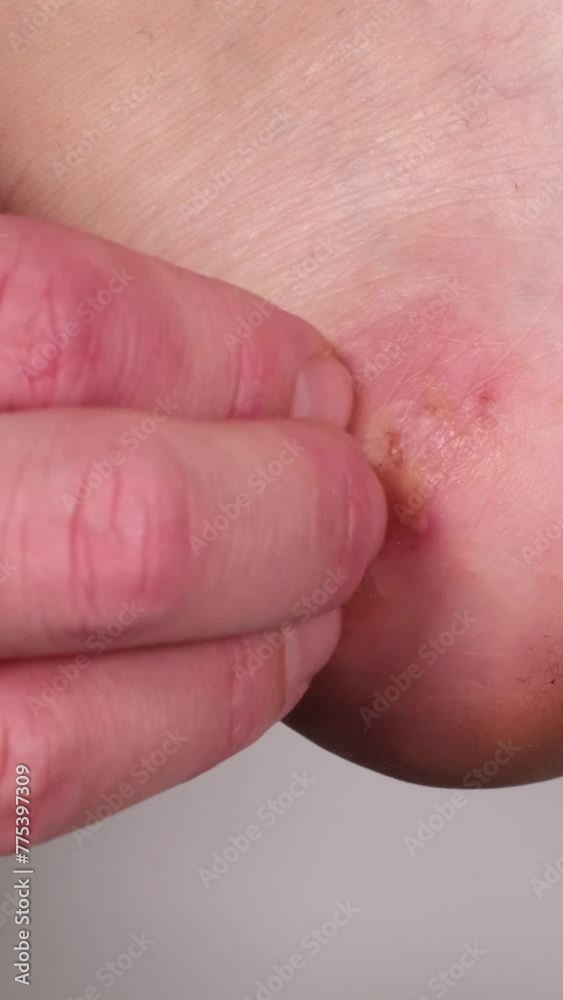 Woman rubbing her heel with her finger. Huge wound on female foot after several confluent blisters of eczema. Acute psoriasis, chemical irritation, allergic reaction, dermatological disease on foot. Woman rubbing her heel with her finger. Huge wound on female foot after several confluent blisters of eczema. Acute psoriasis, chemical irritation, allergic reaction, dermatological disease on foot.