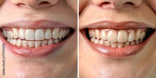 Woman teeth before and after whitening. Dental clinic patient. Oral care dentistry, stomatology, dental transformation. Collage with photos of patient before and after teeth whitening