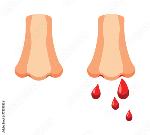 Set of illustrations. Healthy human nose. Nosebleeds occur due to a fight, illness, or high blood pressure.