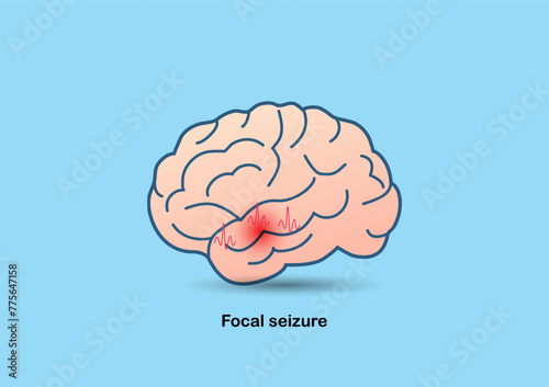 Illustration of brain and abnormal brain waves representing temporal lobe epilepsy.