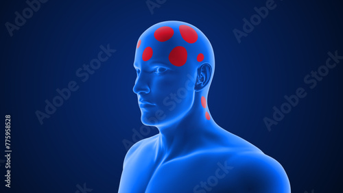 Types of Headache (Thunder clap) 3d illustration