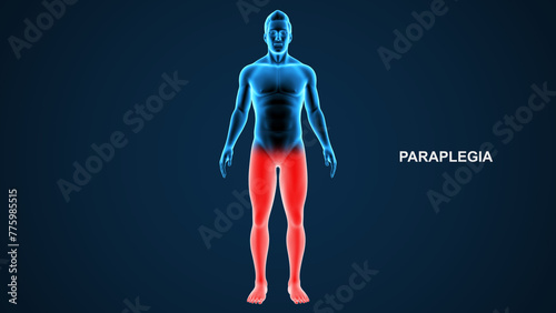 Paraplegia type paralysis 3d Illustration