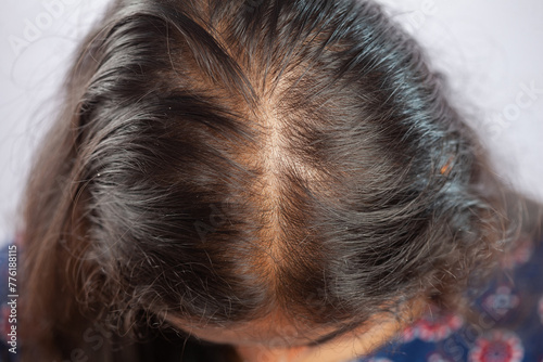 women with messy hair having hair falling or androgenetic alopecia photo