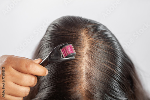 women using dermaroller for collagen induction therapy to treat androgenetic alopecia photo