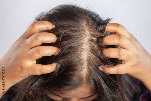hair falling, women suffering from dandruff or head louse scratching her head with hands and showing bald patch on head photo