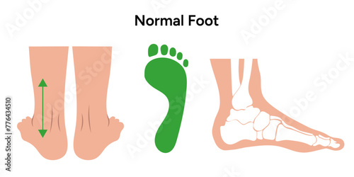 Normal foot