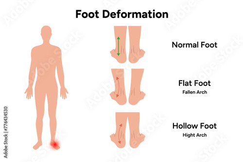 Foot deformation 