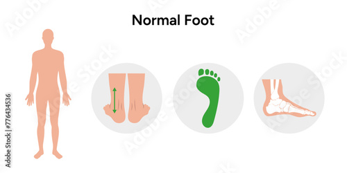 Normal foot