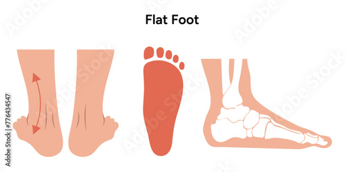 Flat foot deformity 