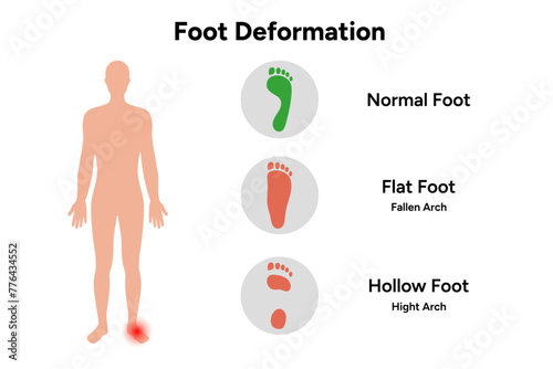 Foot deformation 