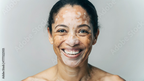 Mujer hermosa con vitíligo en la piel. Chica africana con  presencia de manchas blancas en la piel debido a la falta de pigmentación. Mujer bonita con piel dañada. photo