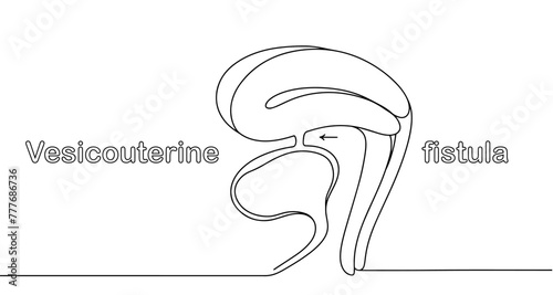 Vesicouterine fistula