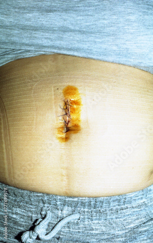 Post-Surgical Abdominal Wound photo