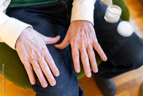senior man vitiligo hand cream photo