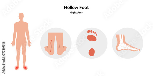 Hollow Foot deformation, higth arch