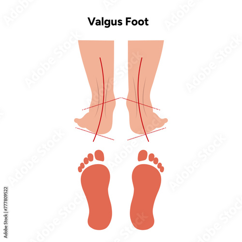 Valgus Foot deformation 
