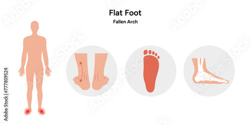 Flat Foot deformation 