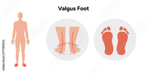Valgus Foot deformation 