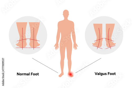 Normal and valgus Foot deformation 