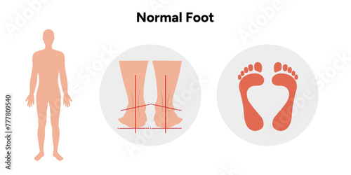 Normal foot