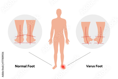Normal and valgus Foot deformation 