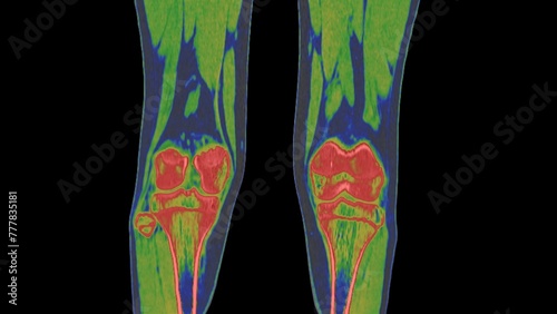 Fotografi Healthy knee, CT scan bone