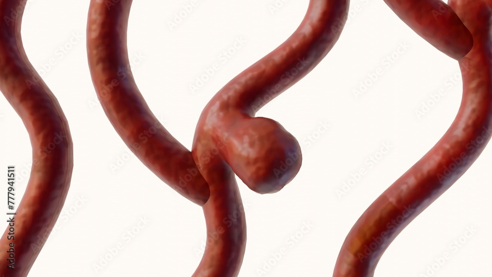 Obraz premium 3d rendering of a saccular aneurysm, also known as a berry aneurysm, is a bulge that forms on the wall of a blood vessel in the brain