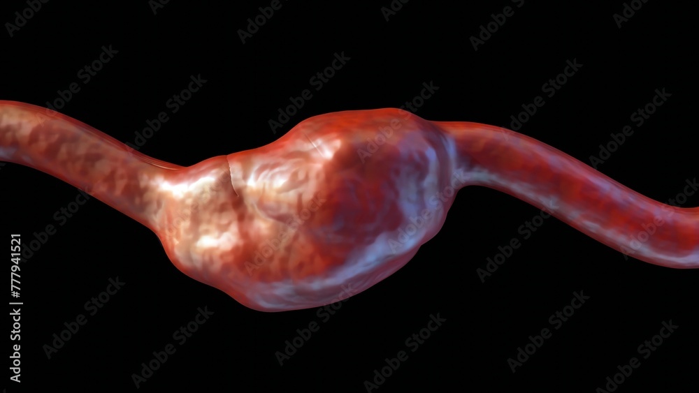 3d rendering of fusiform-shaped aneurysm bulges or balloons out on all ...