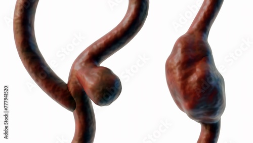 3d rendering of a saccular aneurysm, also known as a berry aneurysm and saccular fusiform photo